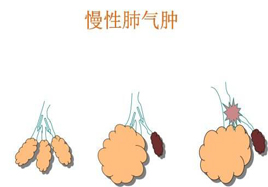 肺氣腫補(bǔ)硒的好處