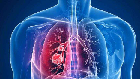 為什么肺部易得癌？每天定量補硒有用嗎？