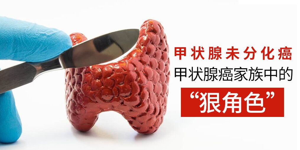 別忽視甲狀腺癌，它的家族也有“狠角色”