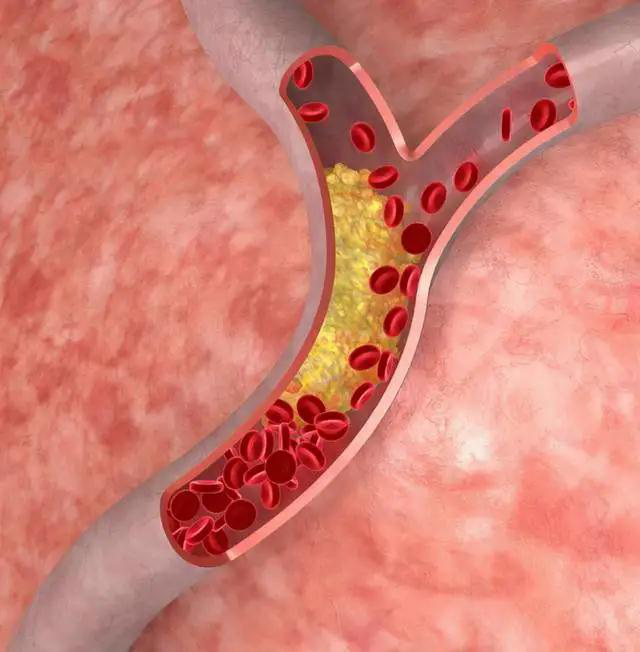 血管堵塞，身體會有這些癥狀，吃點冬蟲夏草降壓降脂護血