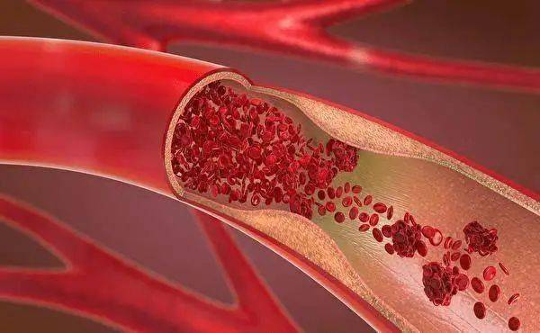 長期服用他汀類患者為什么要補(bǔ)充輔酶Q10？